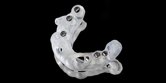 DentalDigital_Bohrschablone_vita DentalDigital Bohrschablone