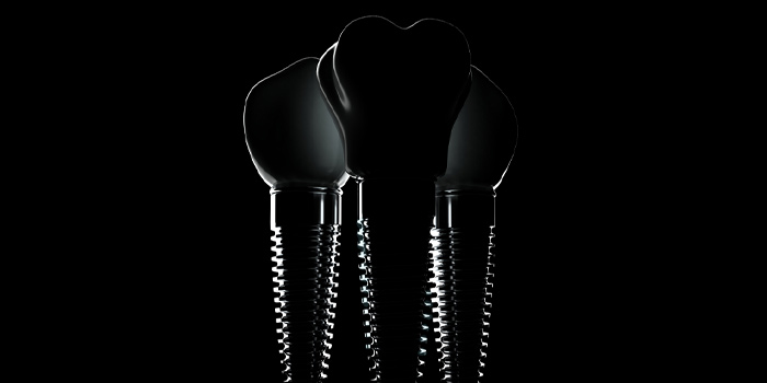DentalDigital_Implantat_vita DentalDigital Implantat