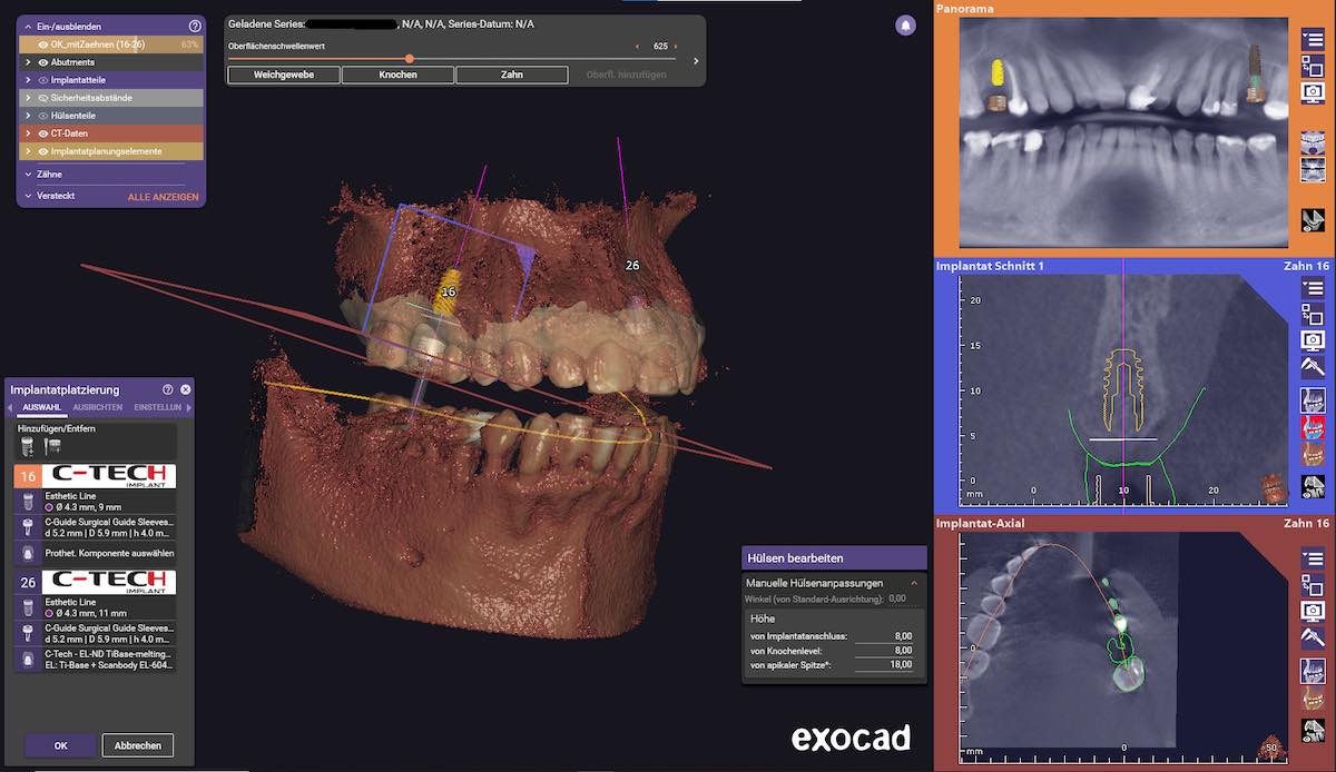 Screenshot-Exoplan Software Dentallabor